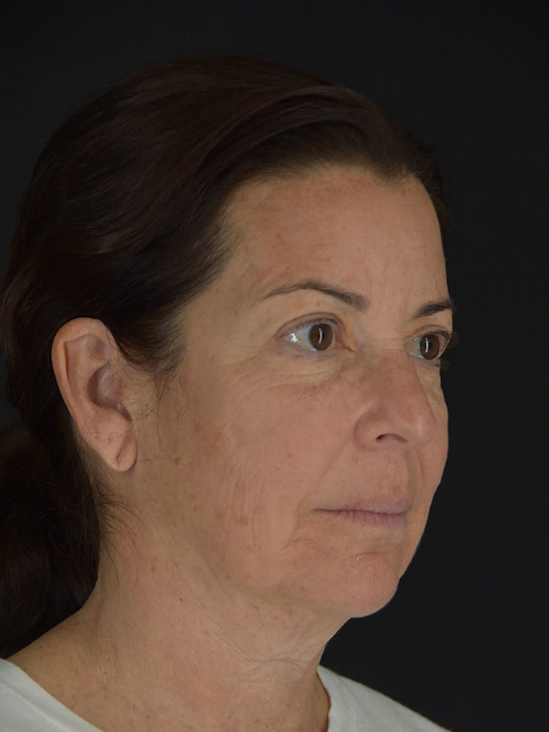 Fat Transfer Before & After Gallery - Patient 933449 - Image 3