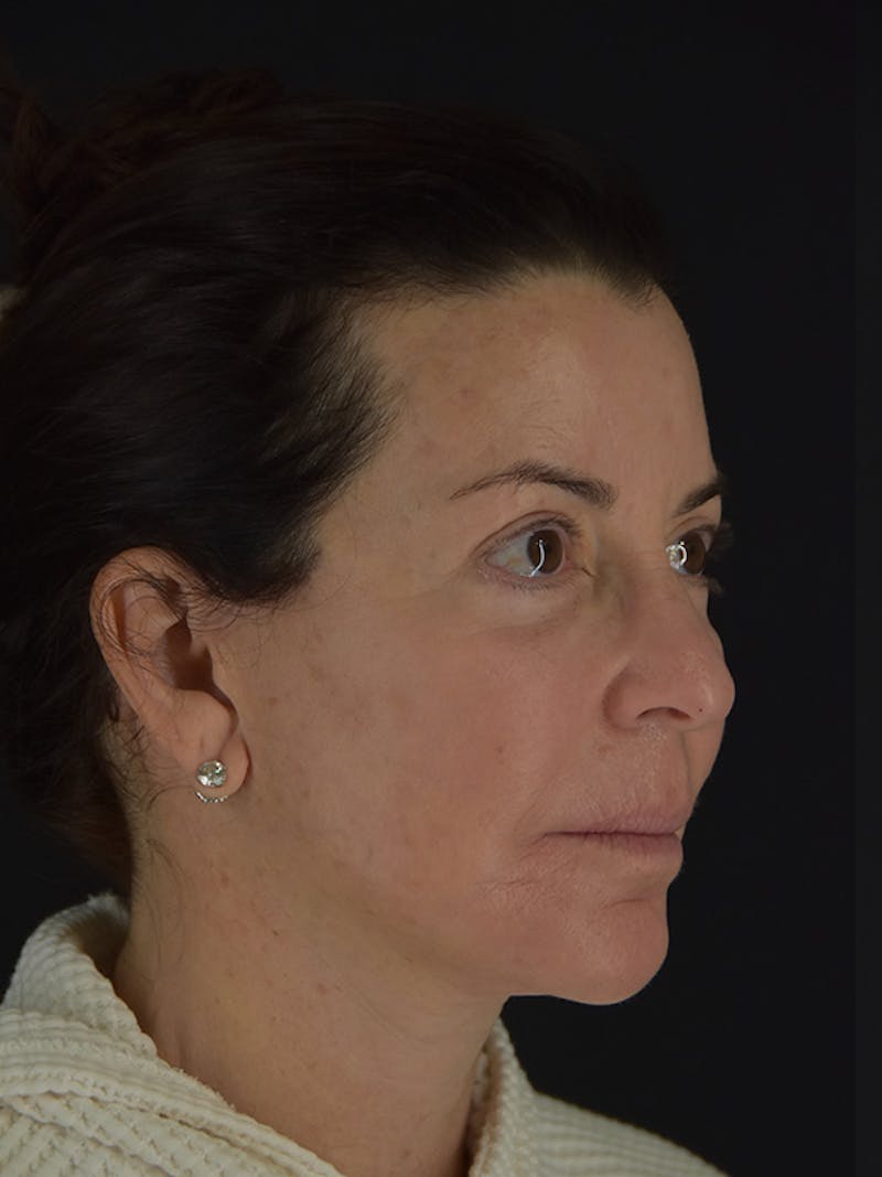 Fat Transfer Before & After Gallery - Patient 933449 - Image 4