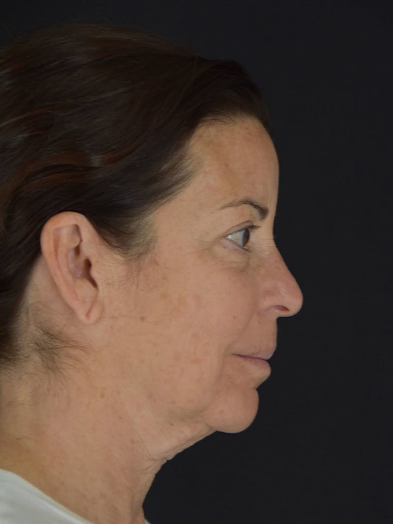 Fat Transfer Before & After Gallery - Patient 933449 - Image 5