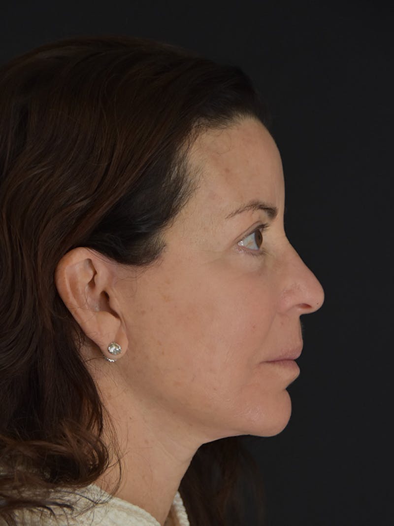 Fat Transfer Before & After Gallery - Patient 933449 - Image 6