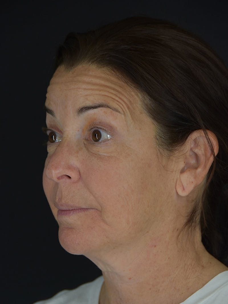 Fat Transfer Before & After Gallery - Patient 933449 - Image 7