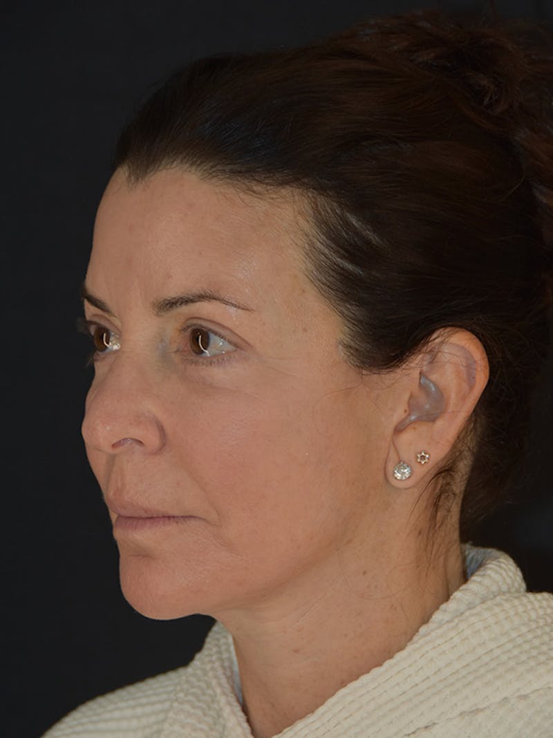 Fat Transfer Before & After Gallery - Patient 933449 - Image 8