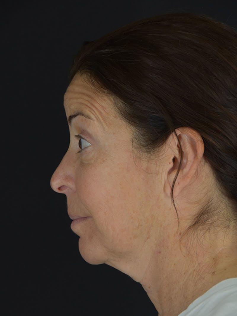 Fat Transfer Before & After Gallery - Patient 933449 - Image 9