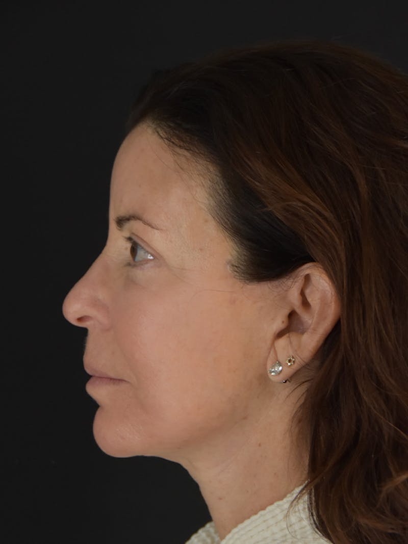 Fat Transfer Before & After Gallery - Patient 933449 - Image 10