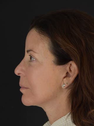 Fat Transfer Before & After Gallery - Patient 933449 - Image 10