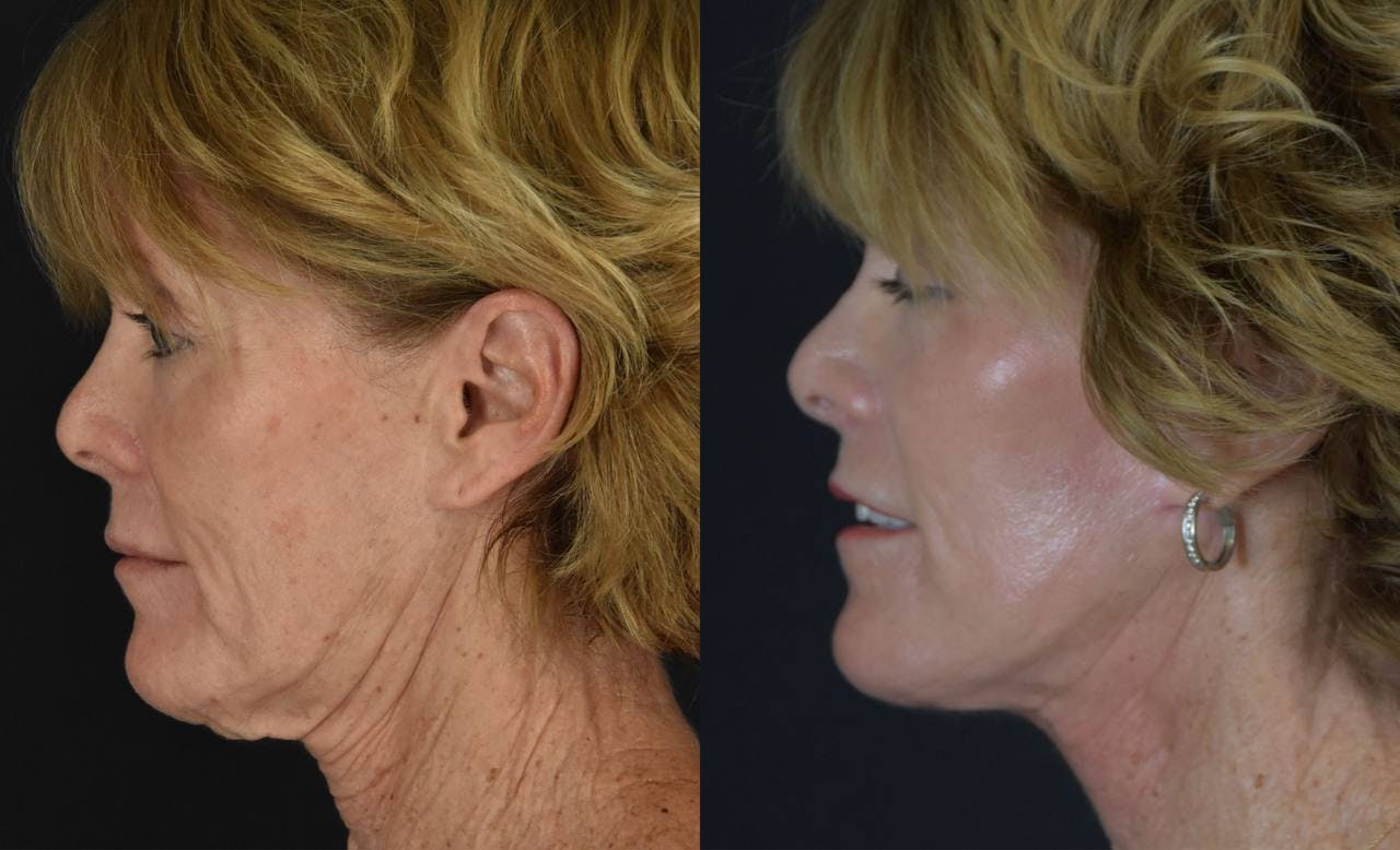 C02 Laser Before & After Gallery - Patient 283517 - Image 5