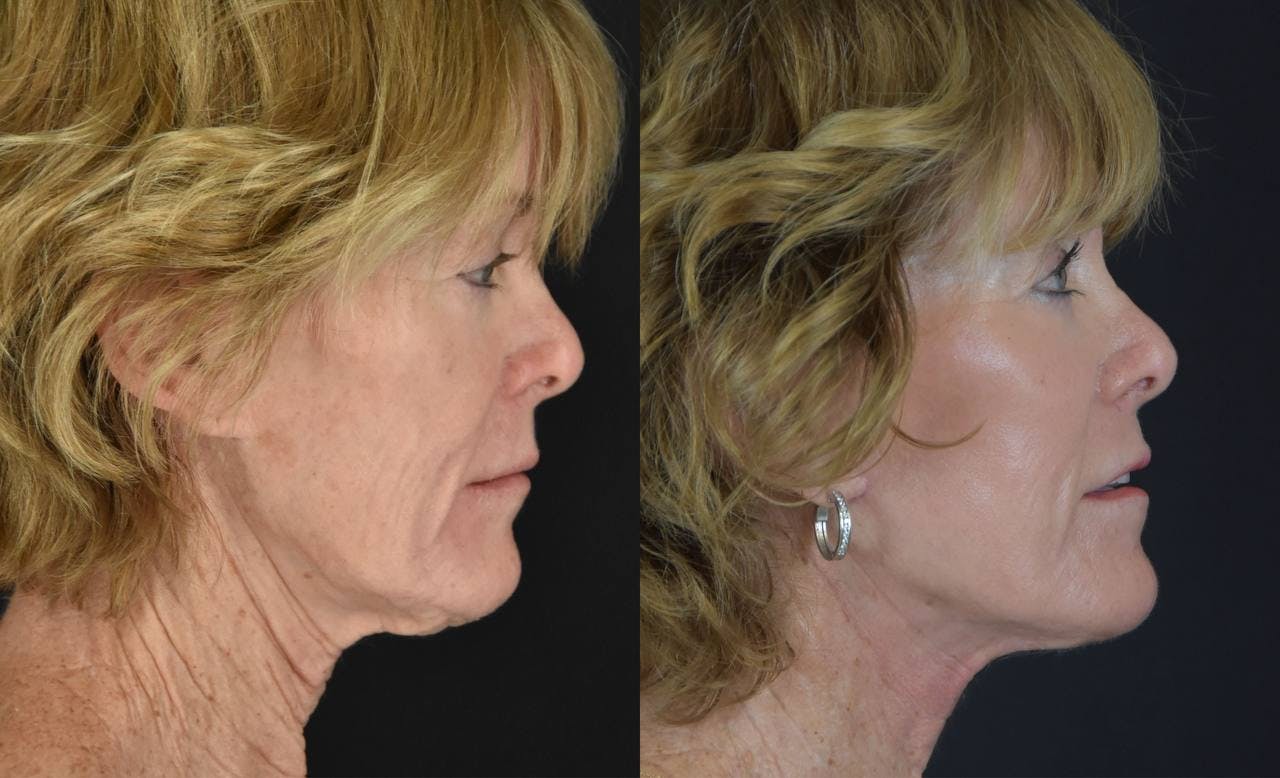 C02 Laser Before & After Gallery - Patient 283517 - Image 3