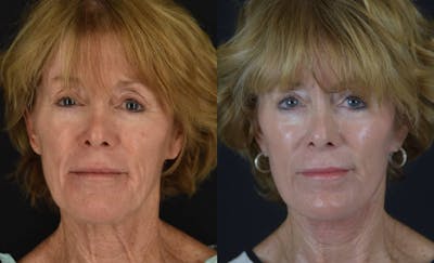 C02 Laser Before & After Gallery - Patient 283517 - Image 1