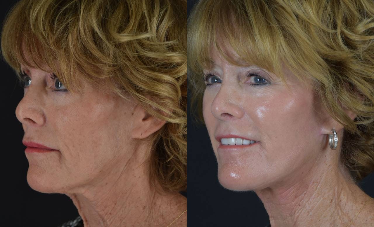 C02 Laser Before & After Gallery - Patient 283517 - Image 4
