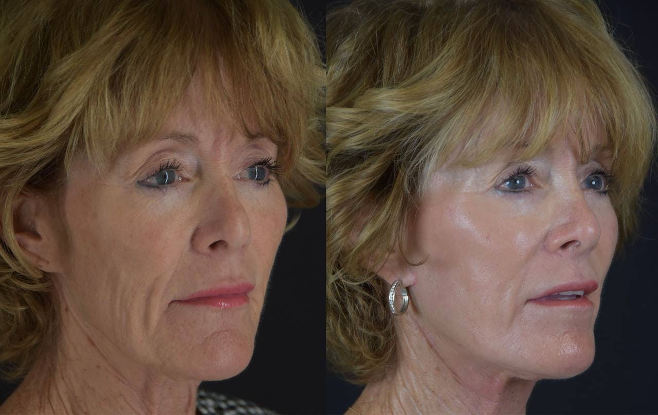 C02 Laser Before & After Gallery - Patient 283517 - Image 2