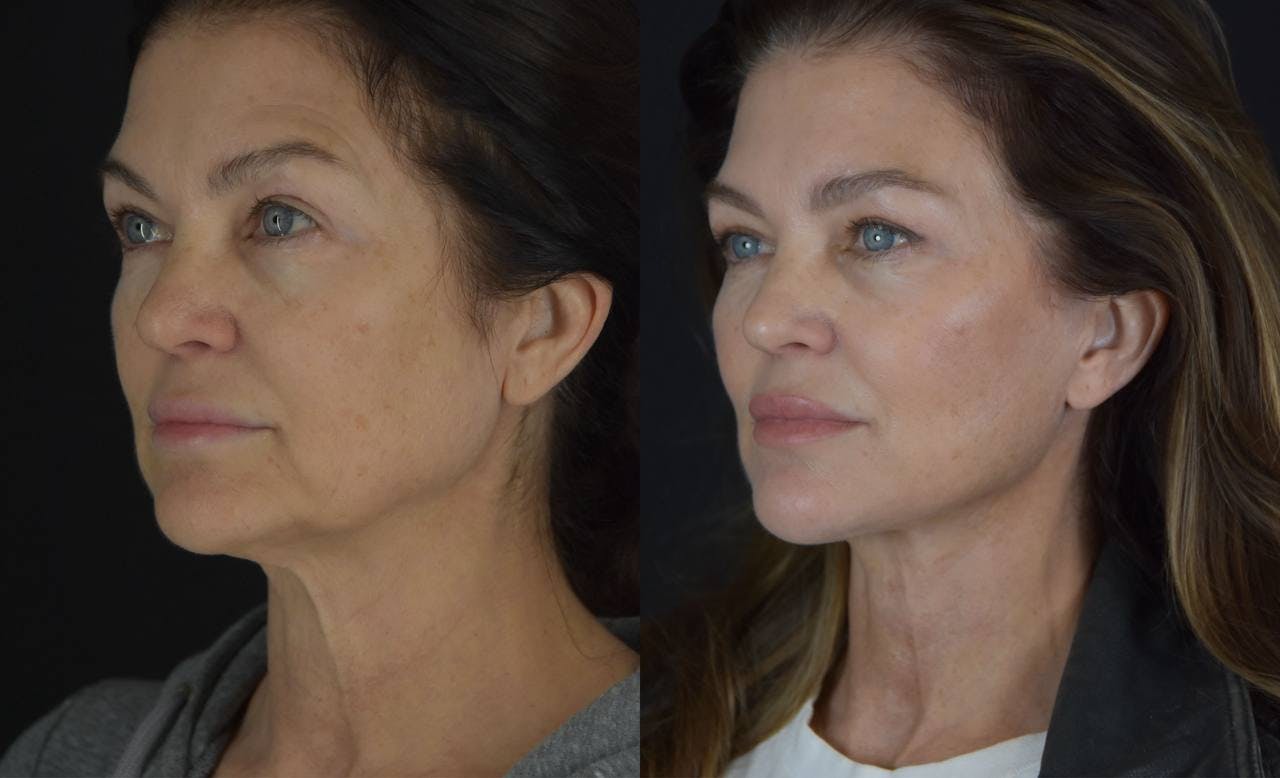 C02 Laser Before & After Gallery - Patient 148112 - Image 5