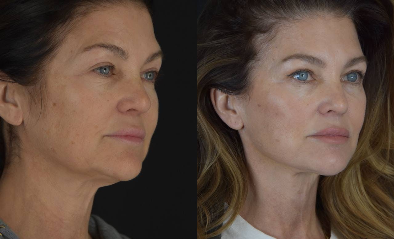 C02 Laser Before & After Gallery - Patient 148112 - Image 3