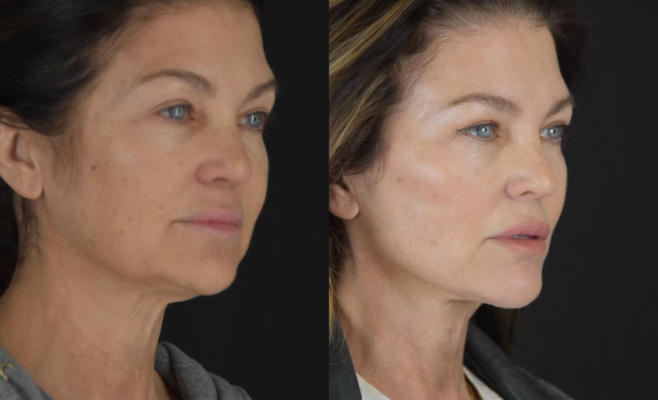 C02 Laser Before & After Gallery - Patient 148112 - Image 2