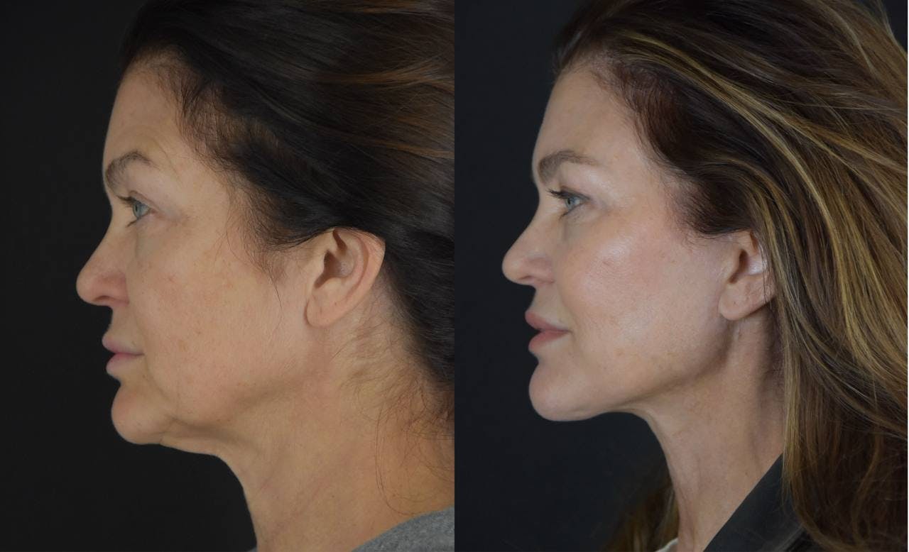 C02 Laser Before & After Gallery - Patient 148112 - Image 6