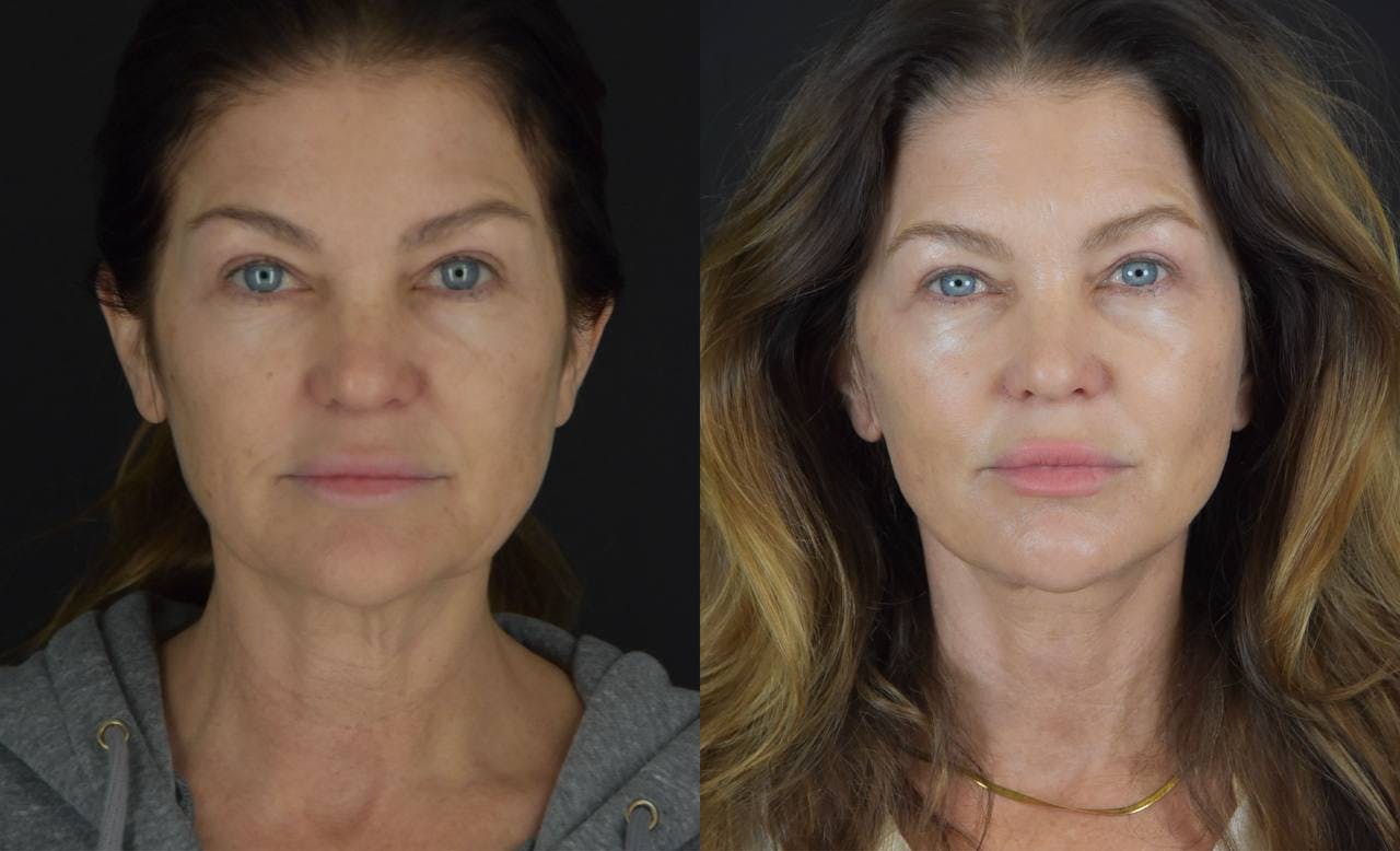 C02 Laser Before & After Gallery - Patient 148112 - Image 1