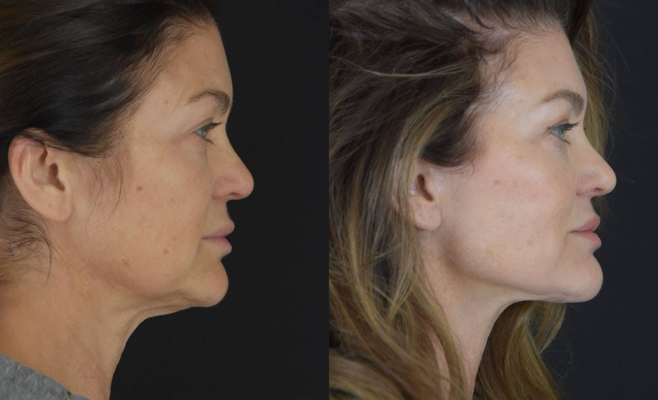 C02 Laser Before & After Gallery - Patient 148112 - Image 4