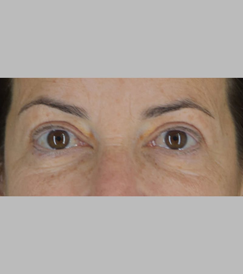 Upper Blepharoplasty Before & After Gallery - Patient 283354 - Image 1