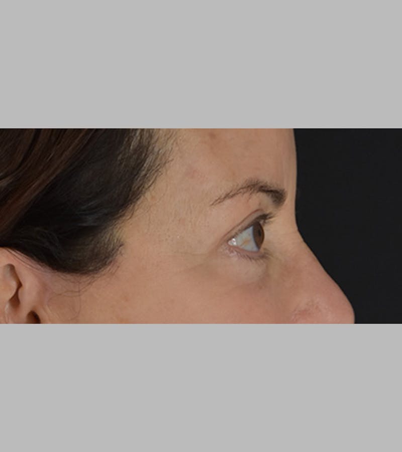 Upper Blepharoplasty Before & After Gallery - Patient 283354 - Image 6