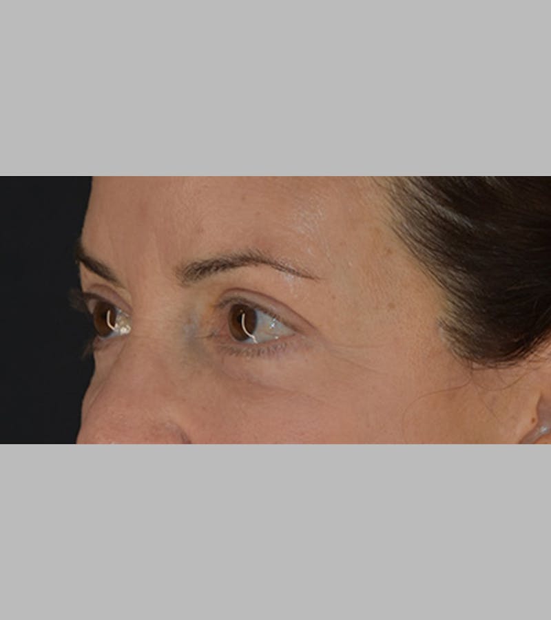 Upper Blepharoplasty Before & After Gallery - Patient 283354 - Image 8