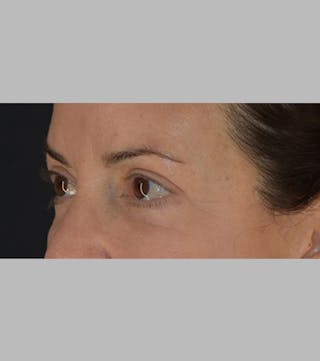 Upper Blepharoplasty Before & After Gallery - Patient 283354 - Image 8