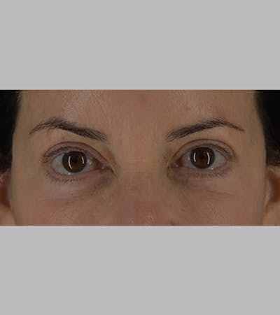 Upper Blepharoplasty Before & After Gallery - Patient 283354 - Image 2
