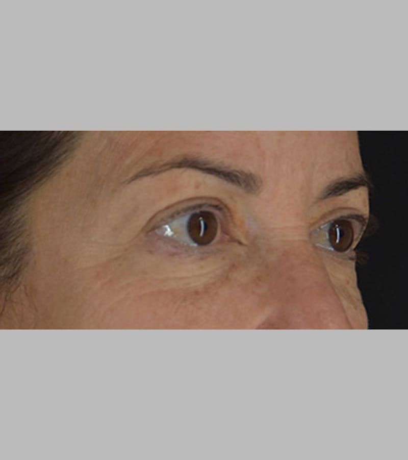 Upper Blepharoplasty Before & After Gallery - Patient 283354 - Image 3