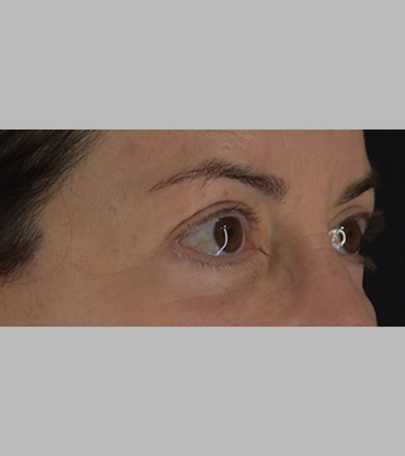 Upper Blepharoplasty Before & After Gallery - Patient 283354 - Image 4