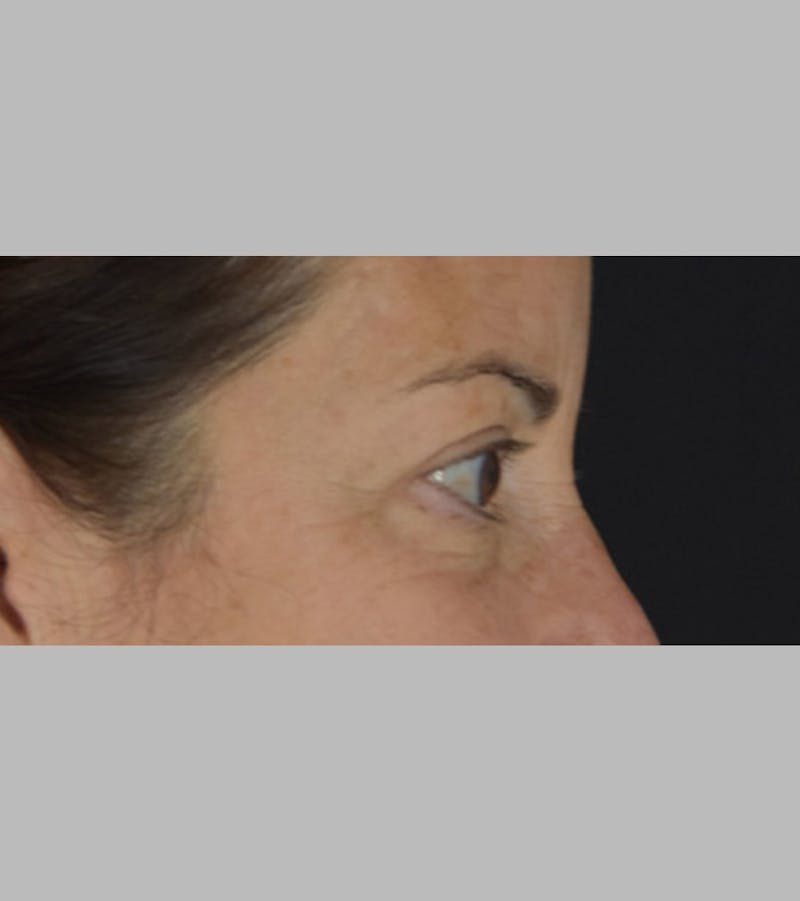 Upper Blepharoplasty Before & After Gallery - Patient 283354 - Image 5