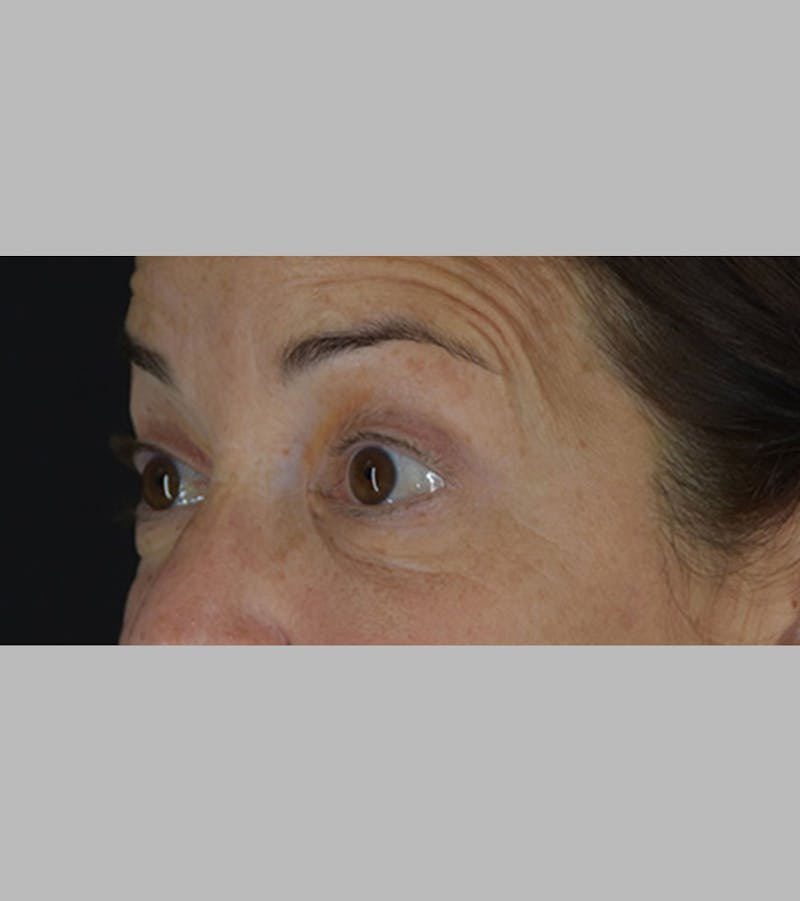 Upper Blepharoplasty Before & After Gallery - Patient 283354 - Image 7