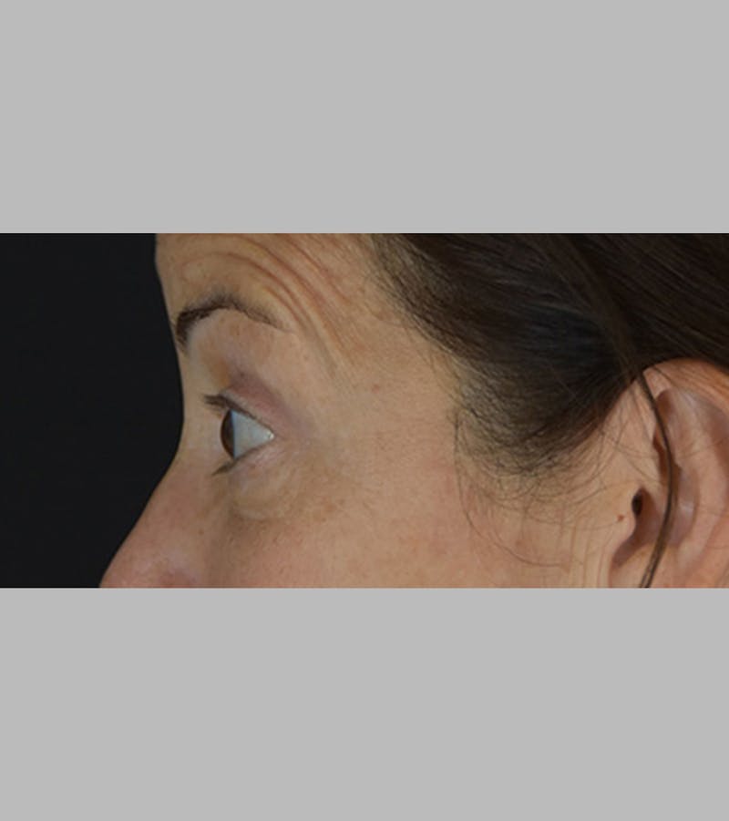 Upper Blepharoplasty Before & After Gallery - Patient 283354 - Image 9