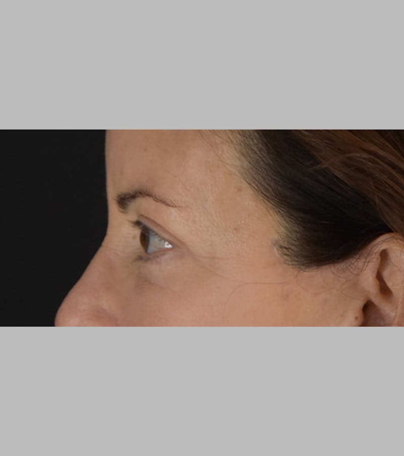 Upper Blepharoplasty Before & After Gallery - Patient 283354 - Image 10
