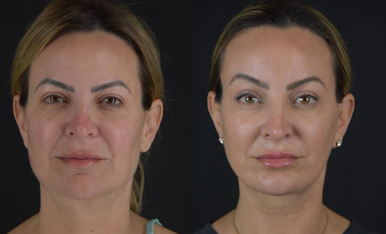 Brow Lift Before & After Gallery - Patient 345976 - Image 1