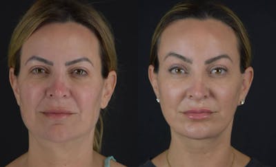 Brow Lift Before & After Gallery - Patient 345976 - Image 1