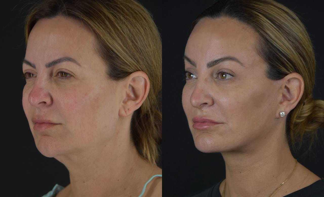 Brow Lift Before & After Gallery - Patient 345976 - Image 5
