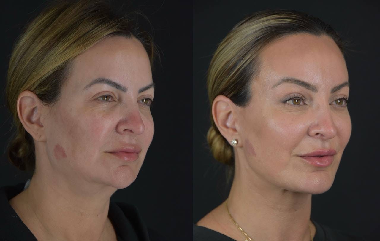 Brow Lift Before & After Gallery - Patient 345976 - Image 3