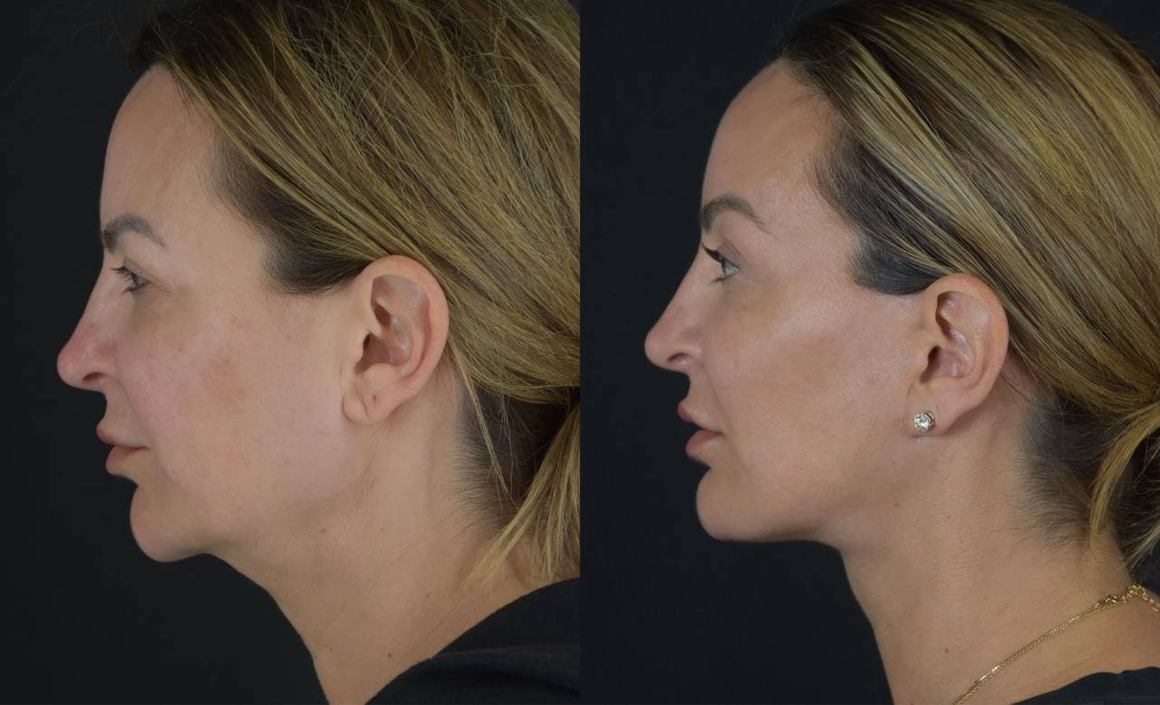 Brow Lift Before & After Gallery - Patient 345976 - Image 6