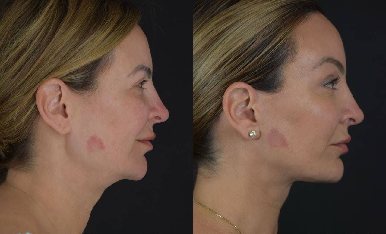 Brow Lift Before & After Gallery - Patient 345976 - Image 4