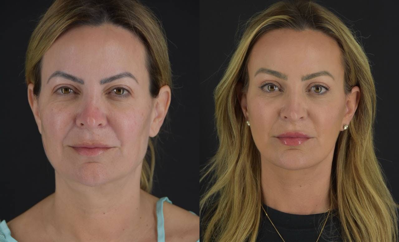 Brow Lift Before & After Gallery - Patient 345976 - Image 2