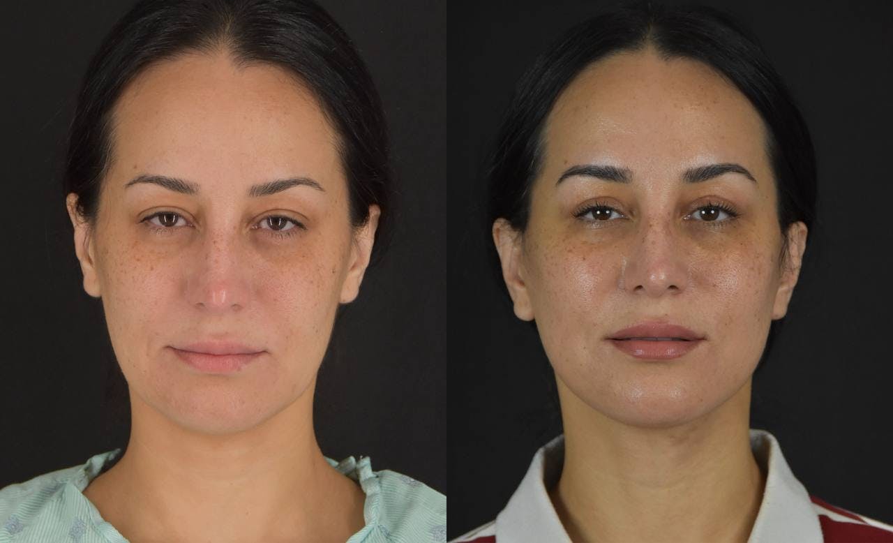 Neck Lift Before & After Gallery - Patient 170003 - Image 1