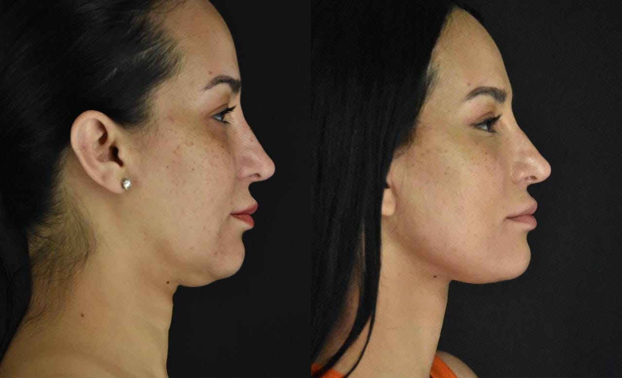 Neck Lift Before & After Gallery - Patient 170003 - Image 3