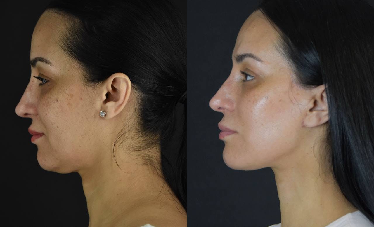 Neck Lift Before & After Gallery - Patient 170003 - Image 4