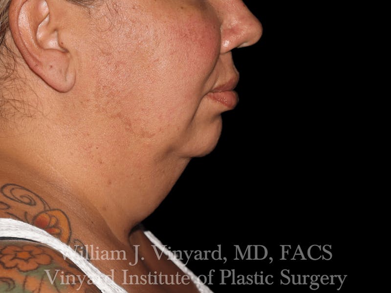 Facetite Before & After Gallery - Patient 169742910 - Image 1