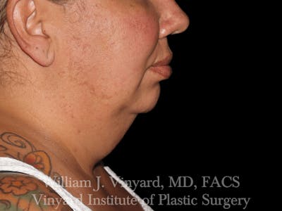 Facetite Before & After Gallery - Patient 169742910 - Image 1