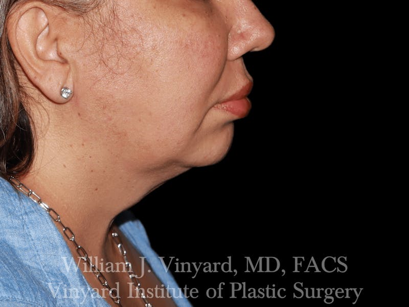 Facetite Before & After Gallery - Patient 169742910 - Image 2