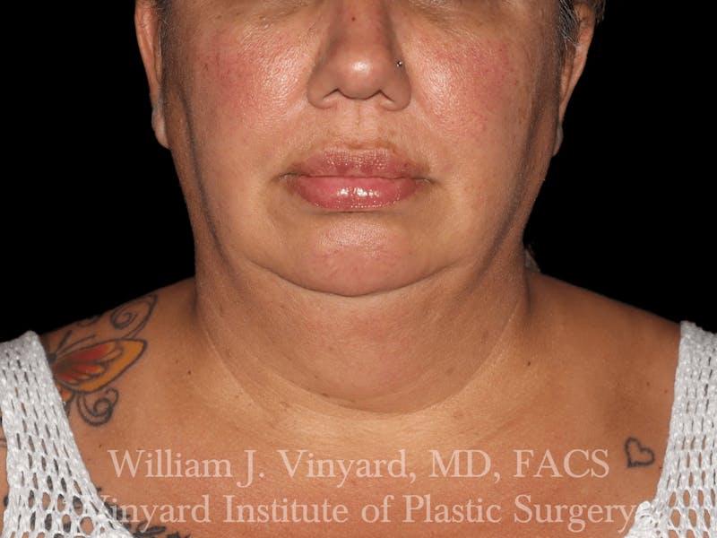 Facetite Before & After Gallery - Patient 169742910 - Image 3