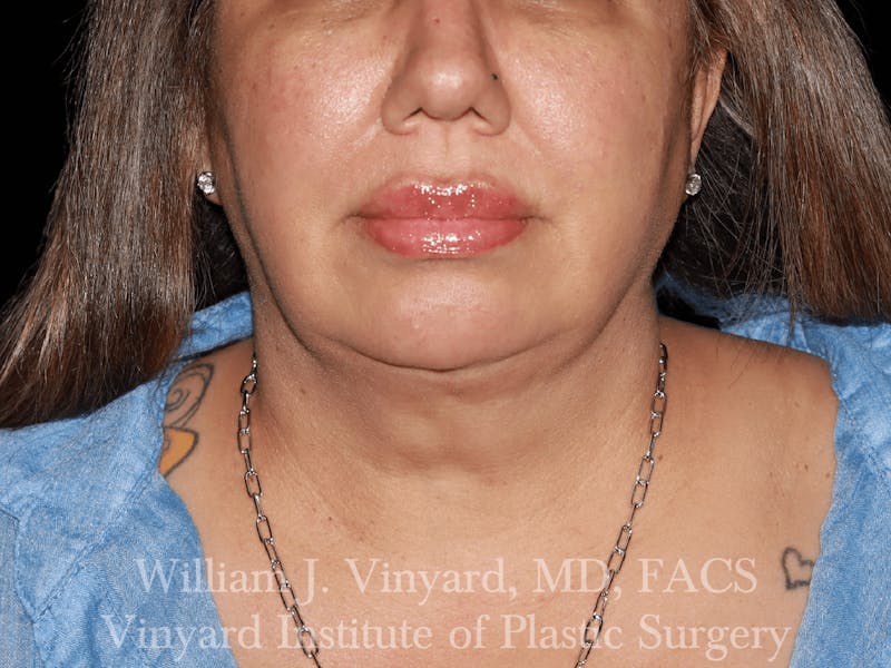 Facetite Before & After Gallery - Patient 169742910 - Image 4