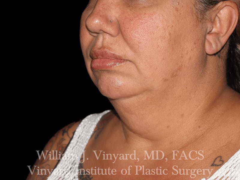 Facetite Before & After Gallery - Patient 169742910 - Image 5