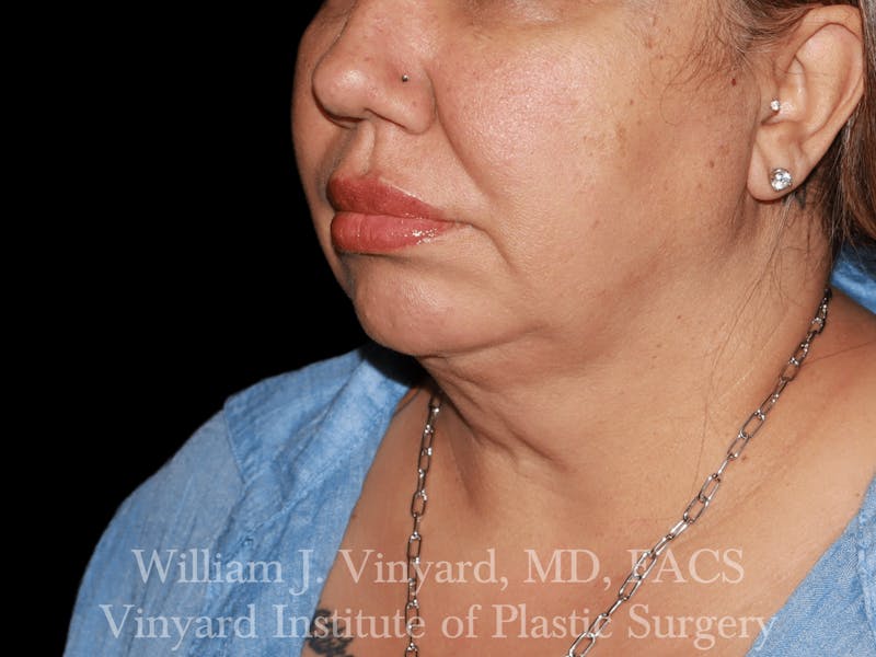 Facetite Before & After Gallery - Patient 169742910 - Image 6