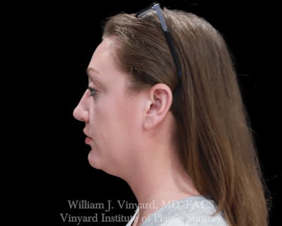 Facetite Before & After Gallery - Patient 169742916 - Image 1