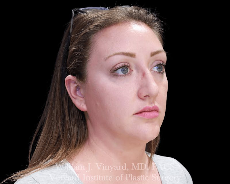 Facetite Before & After Gallery - Patient 169742916 - Image 3